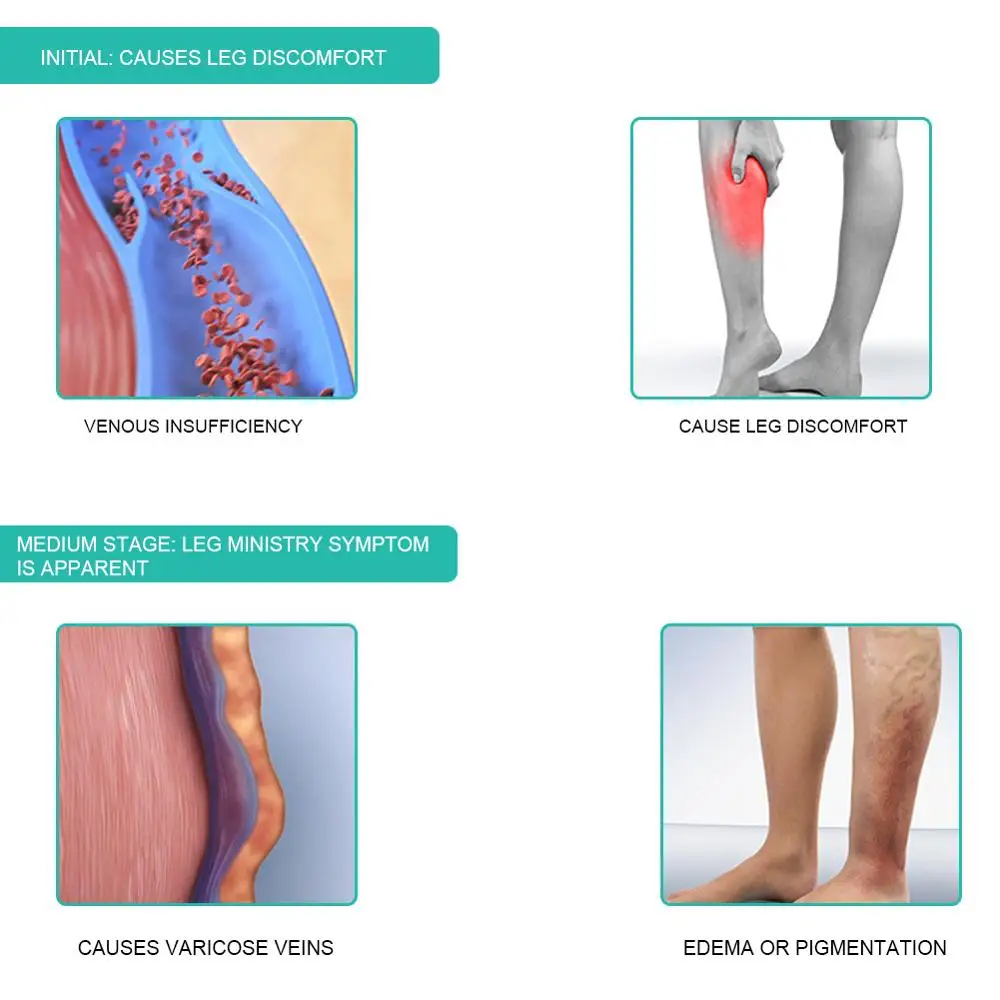 1คู่ถุงเท้าการบีบอัดทางการแพทย - Compression Sleeve Calf บทวิจารณ์และราคา